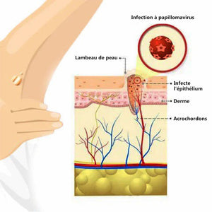 Essence anti-acrochordons et anti-taupes - Achetez 1 obtenez 1 gratuitement (2 pièces)